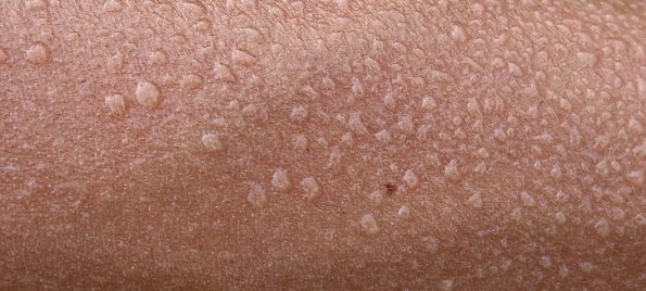 Schweißperlen auf der Haut. (© Minghong, Wikipedia)